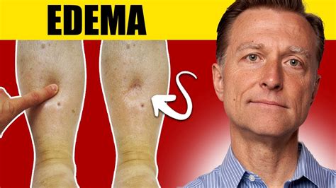 Edema: Types, Causes, Symptoms, and Treatment